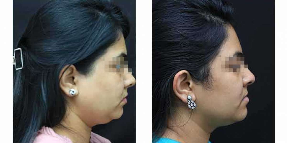 Double Chin Can Be Reduced! At Top DNA Skin Clinic