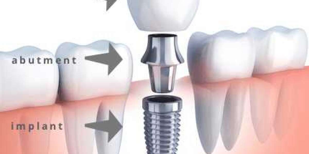 Replace Missing Teeth by Getting Dental Implants