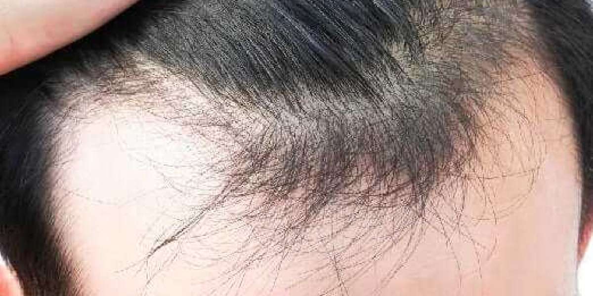 Opt for Hair Transplant & Say GoodBye to Baldness
