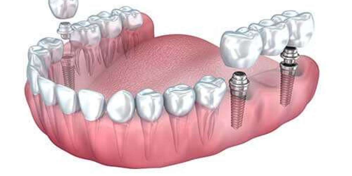 Dental Implants at AK Global Dent
