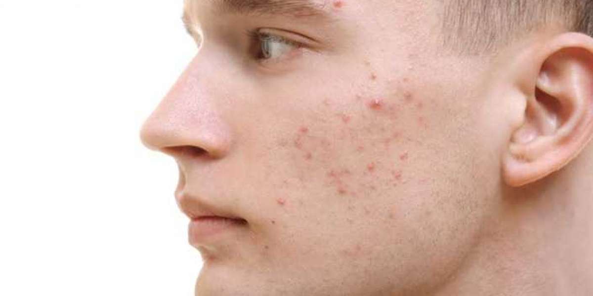 Get Acne Treatment in Ludhiana at Bliss Clinic