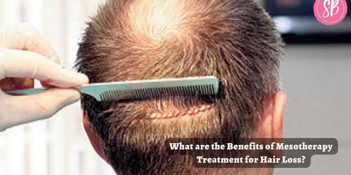 What are the Benefits of Mesotherapy Treatment for Hair Loss?