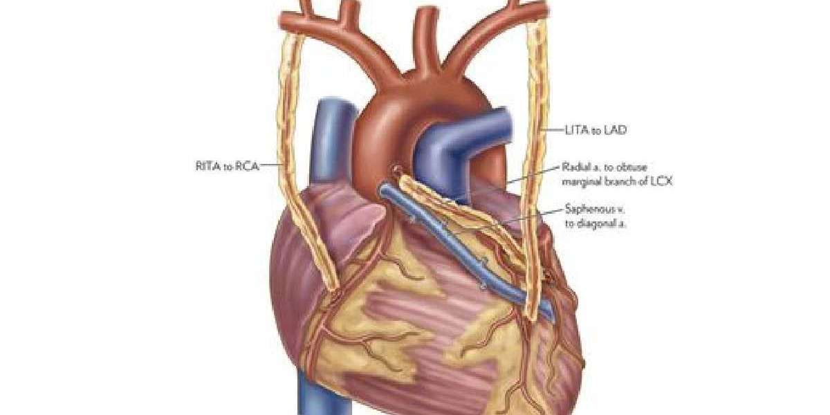 Coronary Bypass Surgery: Objectives, Procedure, and Risks