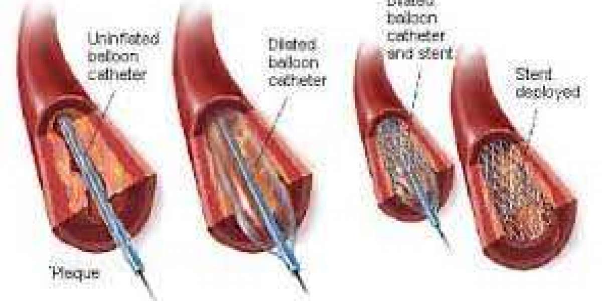 Stent placement Alamgordo: What do you expect from it?
