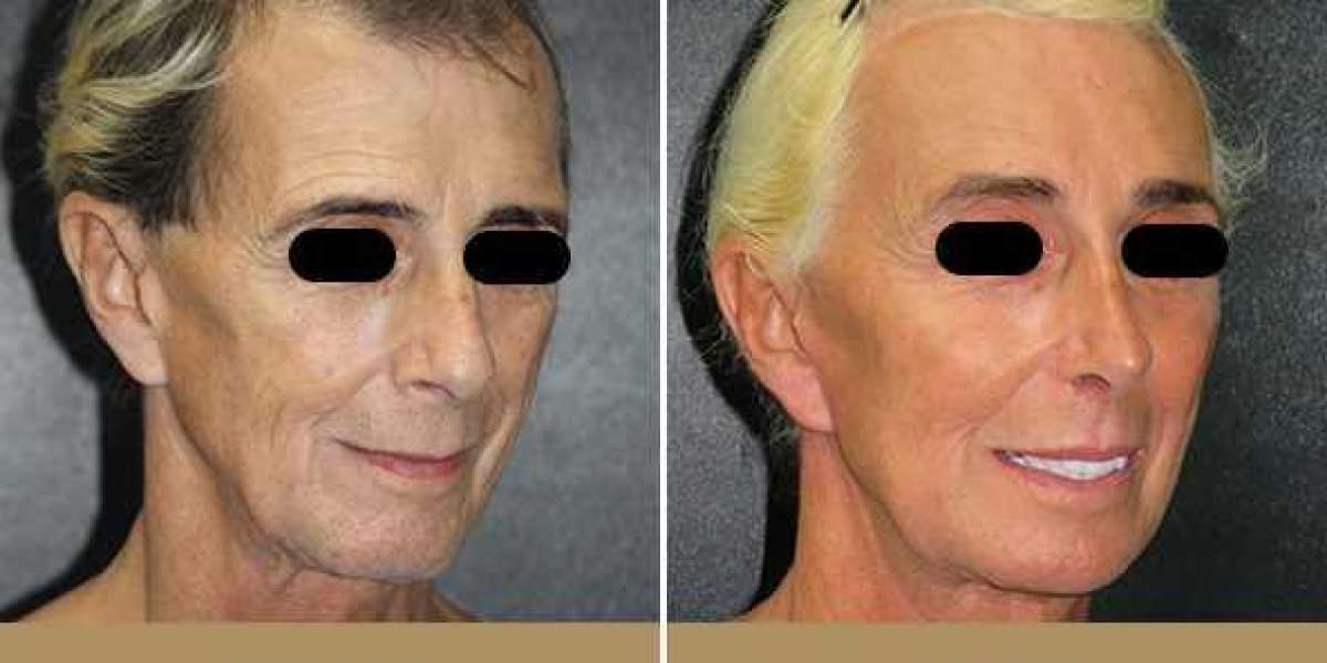 Facial Feminization Surgery: An Advanced Surgery for Male to Female Reassignment