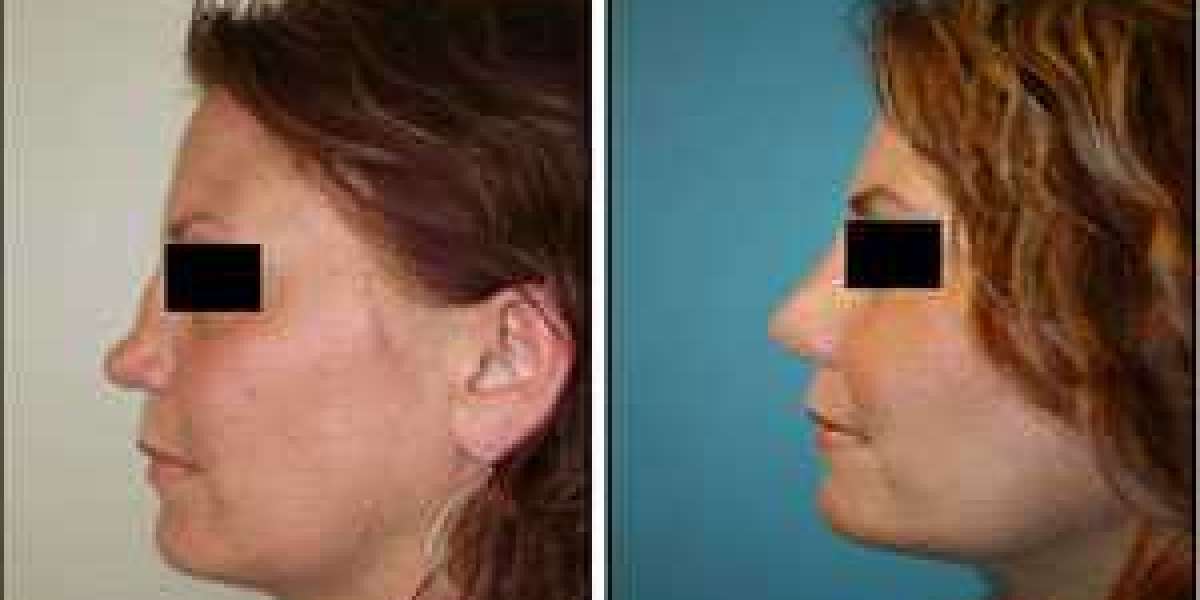 Consult Rhinoplasty Surgeon in Gurgaon to Enhance Nose Appearance