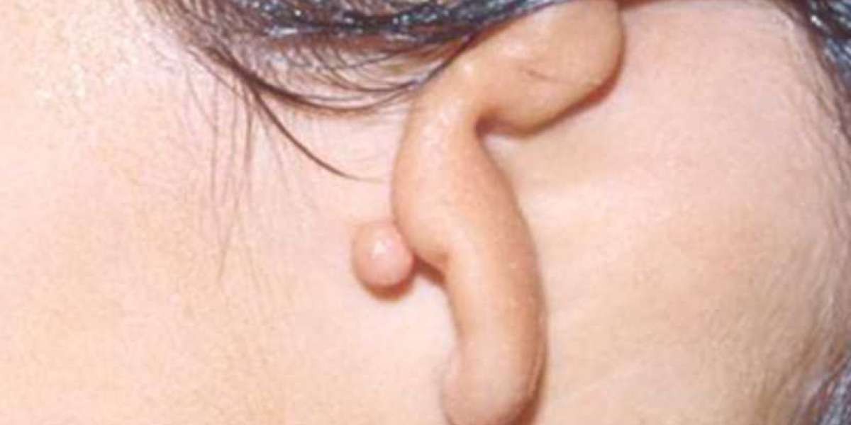 Ear Reconstruction Surgery for Ear Deformities