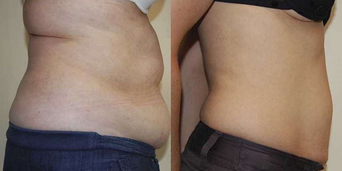 Say Goodbye to Stubborn Fat with SmartLipo Services in Los Angeles: