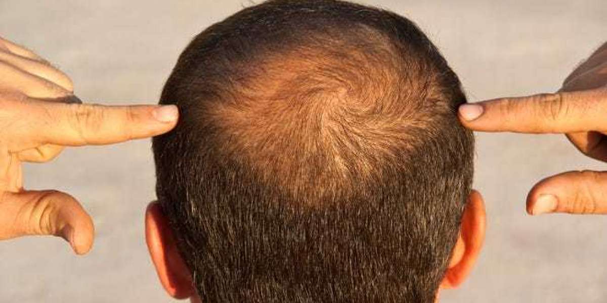 Alopecia Treatment Market Size 2023 | Industry Trends, Growth and Forecast 2028