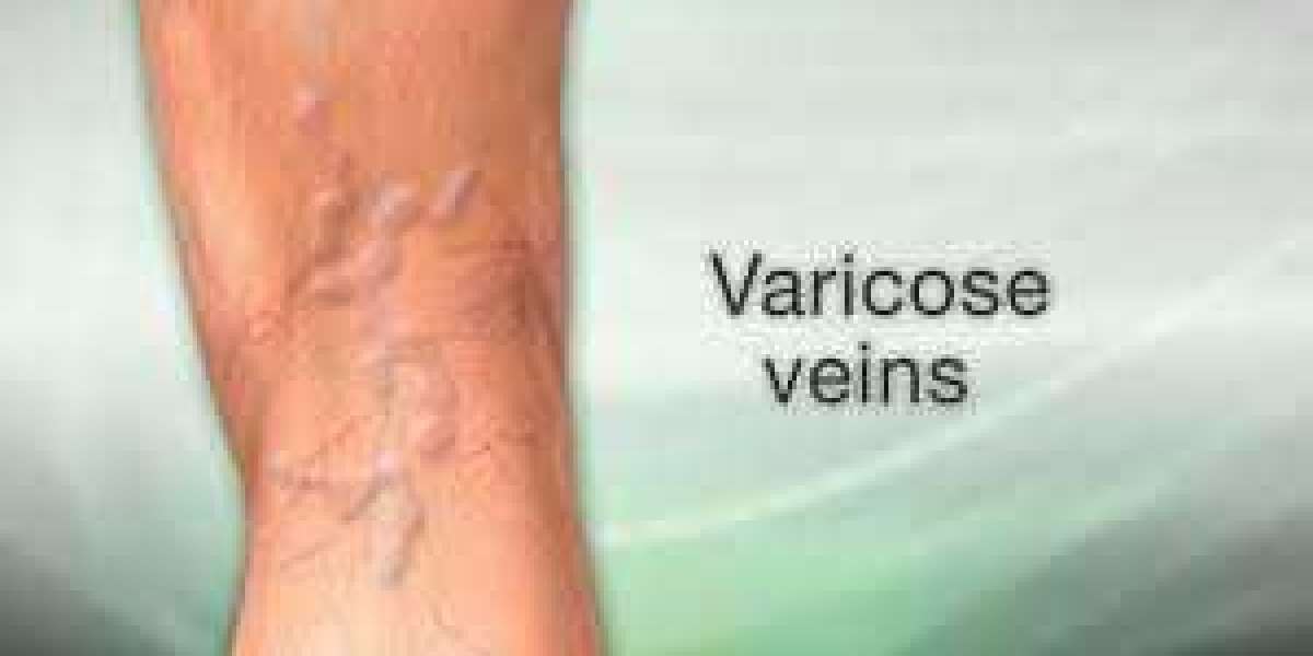 What Is Vein Removal Surgery and Why Is It Import for Varicose veins Treatment?