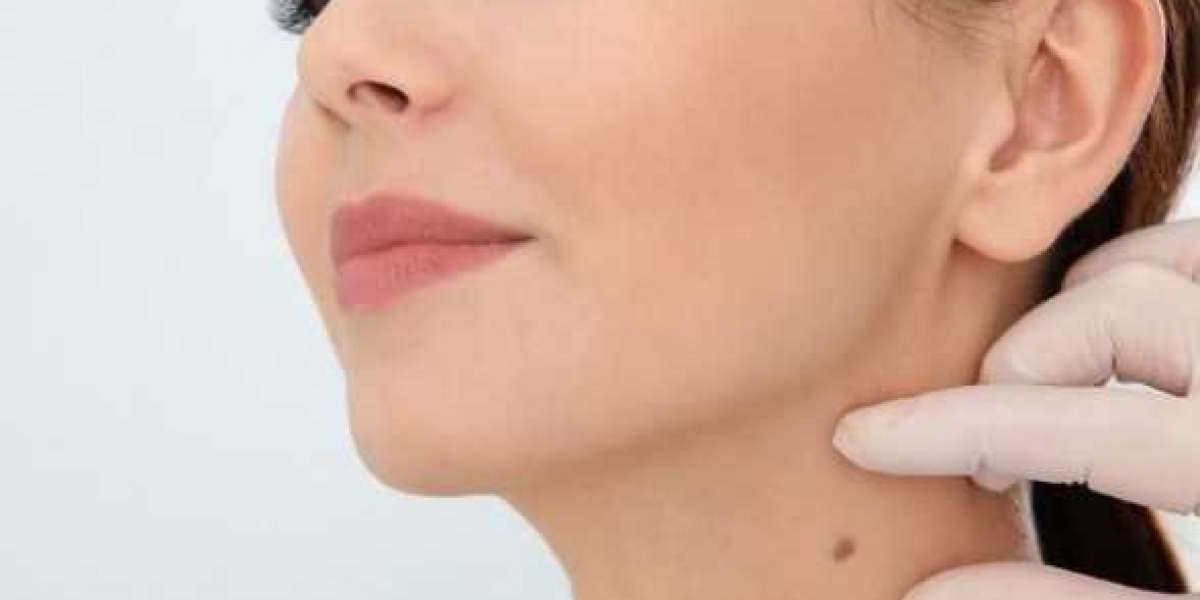 Where to Order Amarose Skin Tag Remover?