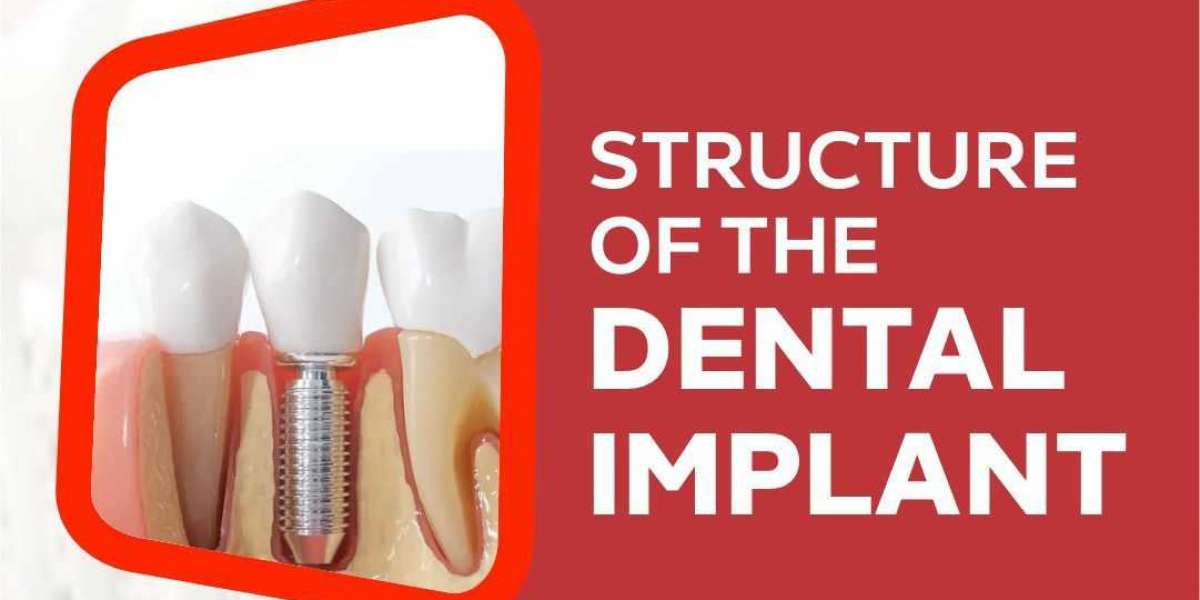 Dental Implants in Dwarka | Best Implantologist in Dwarka | Best Dental Implants in Dwarka | Apex Dental