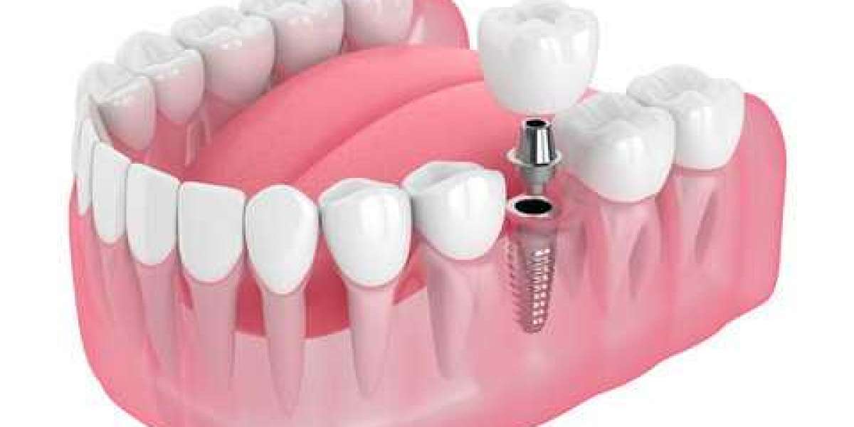 Asia Pacific Dental Implants Market Size Trend Report 2022 Forecast 2032